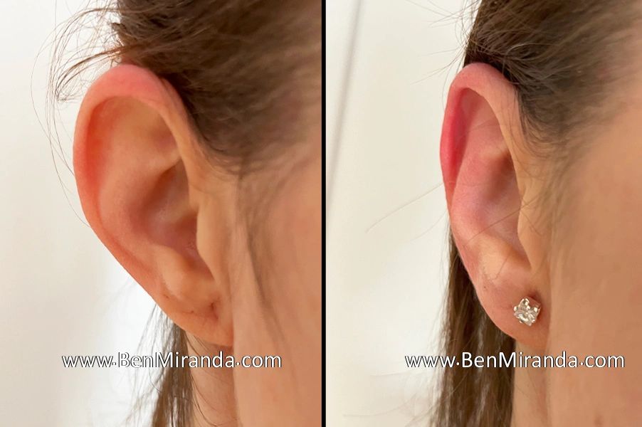 Prominent ear store correction